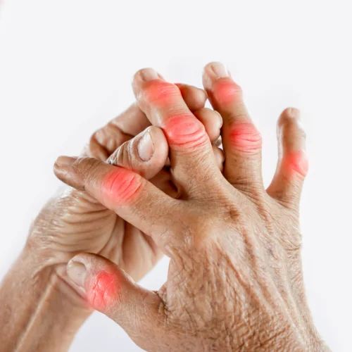 Tratamiento para artrosis y artritis