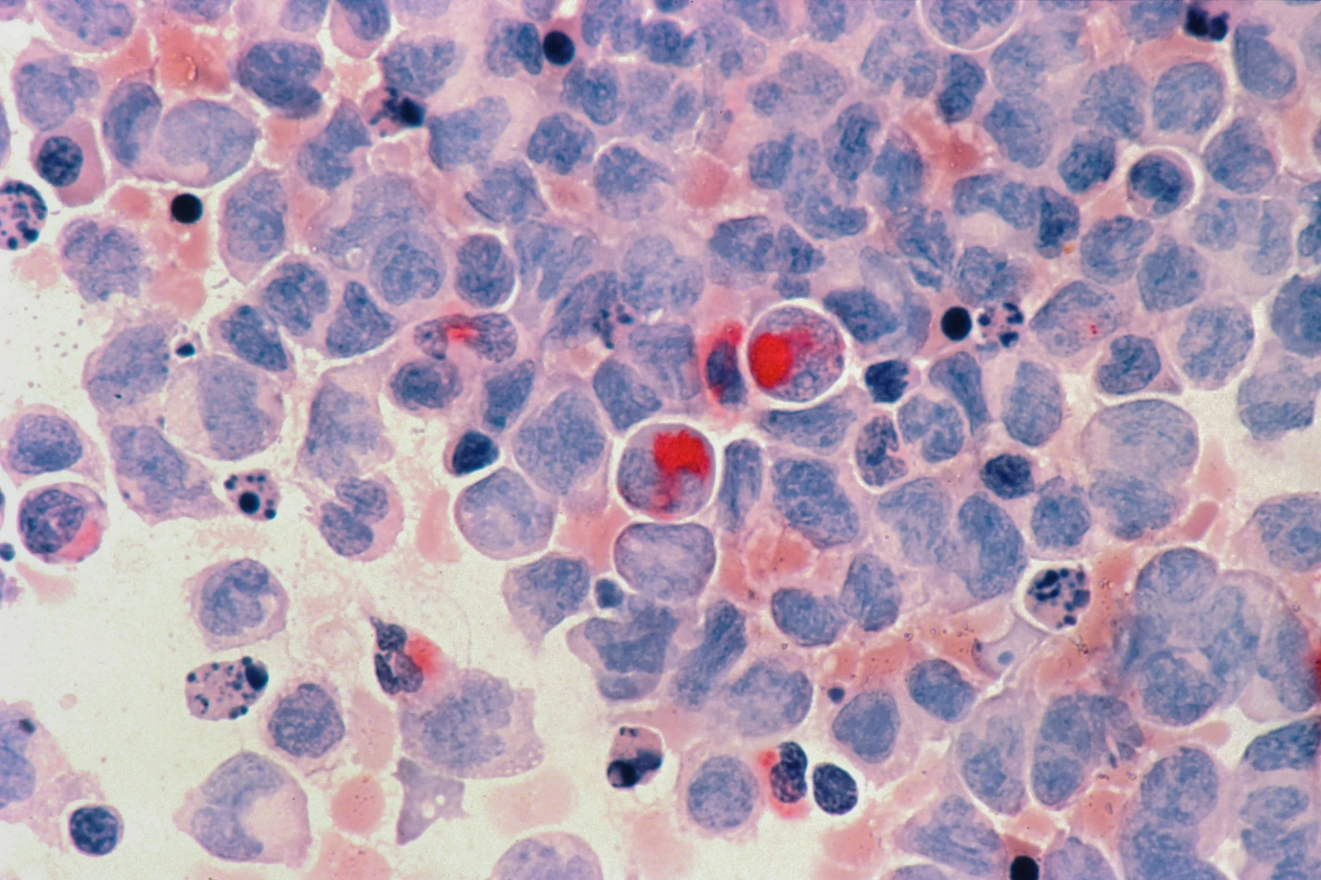 Células cancerosas